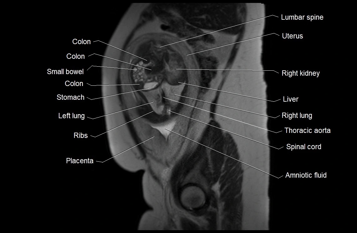 MRI fetal anatomy sagittal image 8.webp